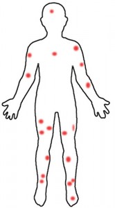 Un grafico de los picaduras en mi cuerpo